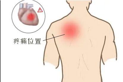 心脏不好左边后背疼图