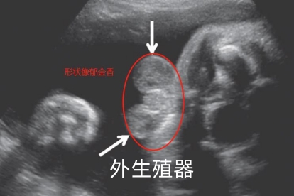 胎儿外生殖异常呈郁金香征图片