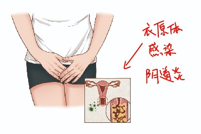 衣原体感染图片